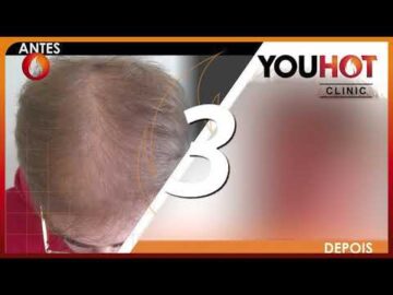 Antes/Depois Tratamento Capilar YouHot - N&ordm;1 em Tratamentos Capilares