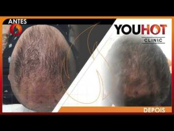 Antes/Depois Tratamento Capilar YouHot - N&ordm;1 em Tratamentos Capilares